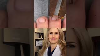 #Doctor reacts: HUGE splinter removal