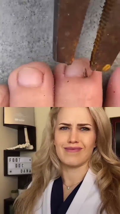 #Doctor reacts: HUGE splinter removal