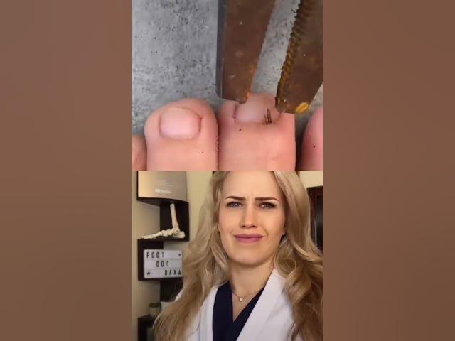 #Doctor reacts: HUGE splinter removal