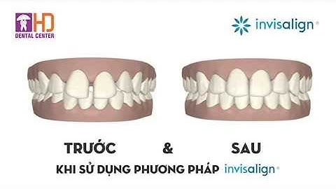 Video 3D Clincheck mô tả quá trình dịch chuyển răng - Nha khoa Dr Hùng & cộng sự