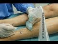 Peripheral Vein Cannulation Using Ultrasound- transverse or longitudinal - which is best