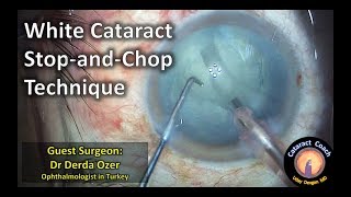 Guest Surgeon White Cataract Stop-and-Chop Cataract Surgery