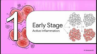 Active inflammation vs fixed scarring in lichen sclerosus | WHC Clinical FAQ