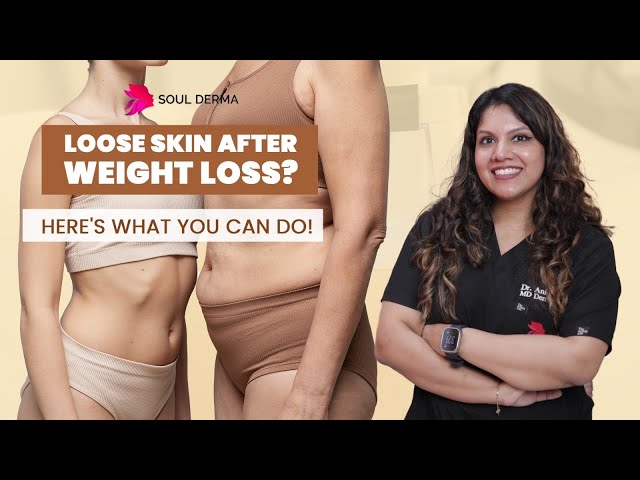 Loose Skin After Weight Loss? Here's What You Can Do! - YouTube Loose Skin After Weight Loss? Here's What You Can Do! - YouTube