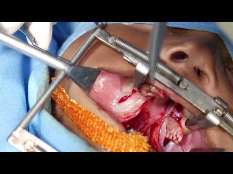 Cleft Palate Surgery: An important surgery for a cleft lip child