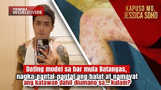 Dating Model Sa Bar, Nagkapantal-Pantal Ang Katawan Dahil Umano Sa Kulam? Kapuso Mo, Jessica Soho