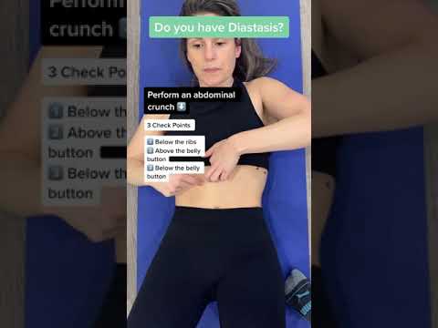 DIASTASIS RECTI Assessment