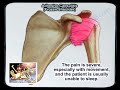 Adhesive Capsulitis Frozen Shoulder - Everything You Need To Know - Dr. Nabil Ebraheim