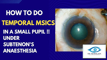 Case series 31. Temporal MSICS under subtenons, hard to dilate, shallow AC, diabetic hypertensive!