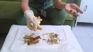 Steril Eldiven Çıkarma