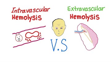 Intravascular Vs Extravascular Hemolytic Anemia; What