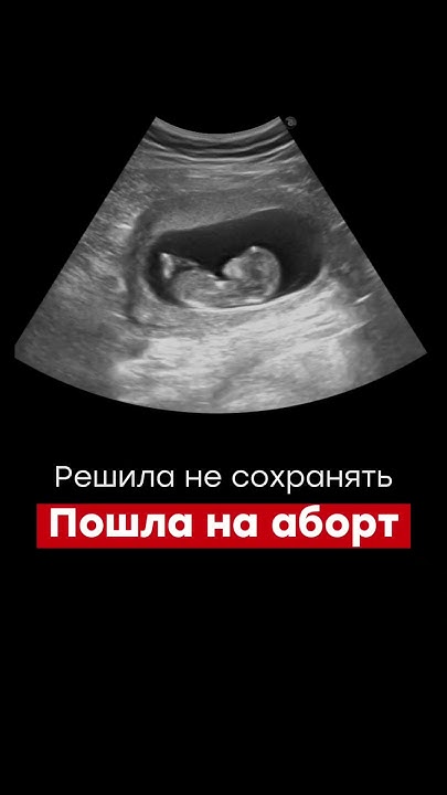 Беременность после аборта - YouTube
