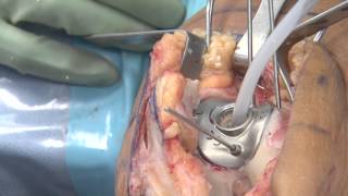 Patellofemoral Inlay Arthroplasty - Dr. Douglas Wyland