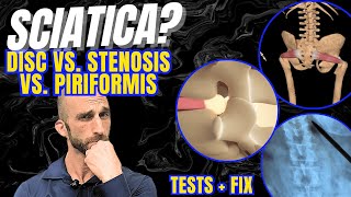 Sciatica? - Piriformis Vs. Disc Vs. Stenosis - Tests Fix Stop Guessing