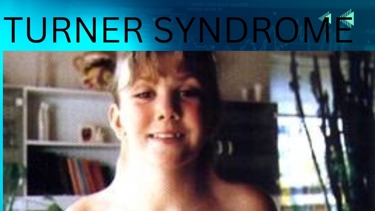 Turner syndrome YouTube