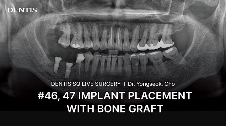 DENTIS SQ LIVE SURGERY ㅣ DENTIS