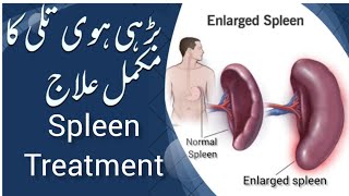 Best treatment of enlarged spleen | diagnosed nafees clinic