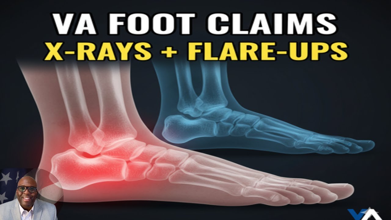 Заболевания стопы VA: подошвенный фасциит, косточки, артрит и деформации пальцев ног (38 CFR 4.71a)