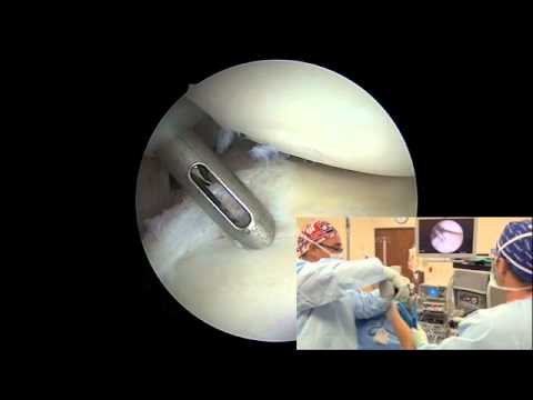 Arthroscopic Posterior Labral Repair - Randy S. Schwartzberg, M.D.