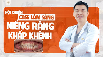 Hội Chẩn Case Lâm Sàng Niềng Răng Khấp Khểnh | Bác sĩ Trung Long Biên