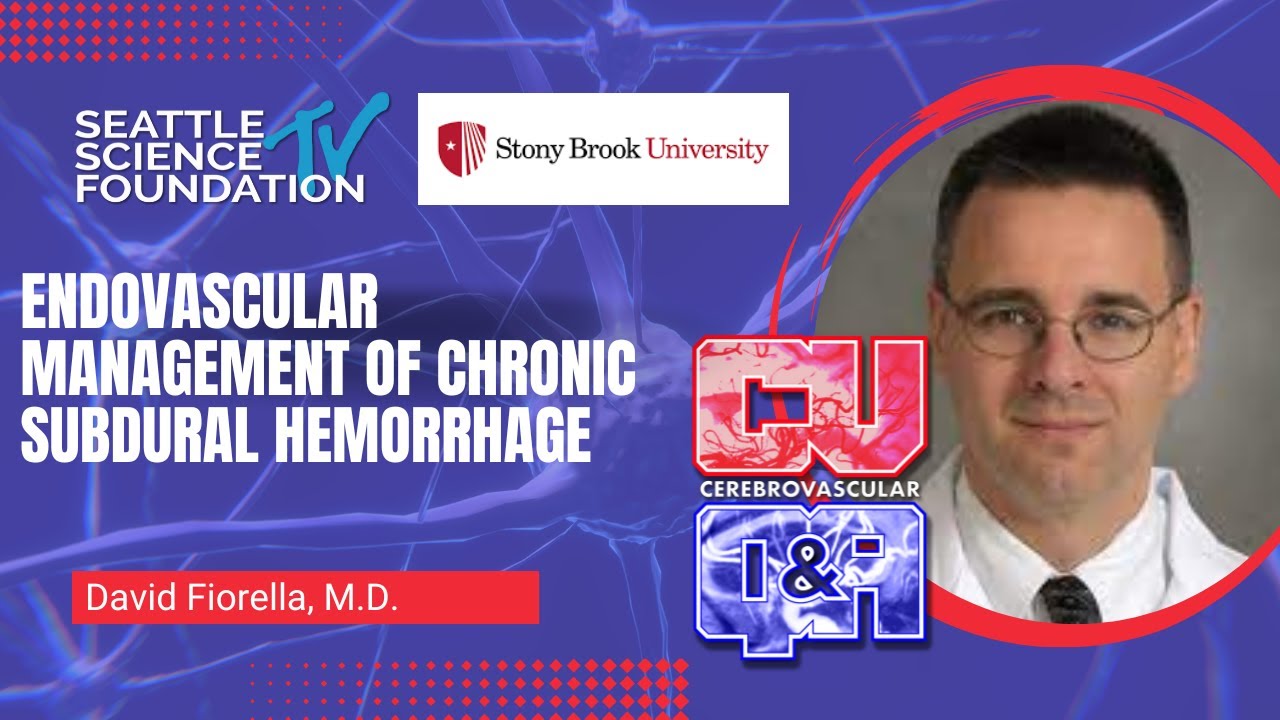 Endovascular Management of Chronic Subdural Hemorrhage - David Fiorella, MD