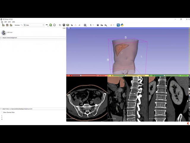 CT Scan Anatomy Using .mrb fie and Dicom File management in 3D Slicer