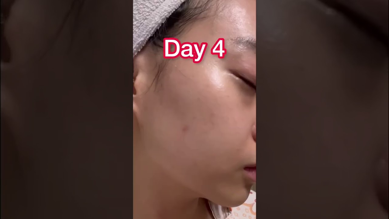 Get rid of acne marks in 7 Days 