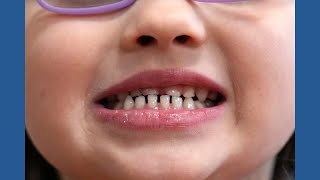 FDA restricts use of kids' fluoride supplements citing emerging health risks