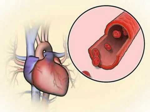 Video: Amoxiclav Gegen Angina Pectoris Bei Erwachsenen: Dosierung, Einnahme