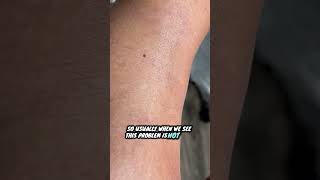 Pitting edema #podiatry #pittingedema #edema #ankleswelling #cankles