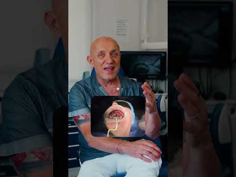 Video Carico Immediato Post-Estrattivo: Estrazione e Impianto Dentale in Un Giorno Solo