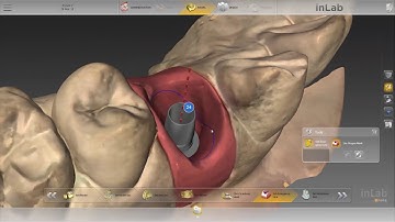CEREC and InLab SW - Digital Custom Abutment and Crown on Tibase, Scan Body - Inlab Dentsply Sirona