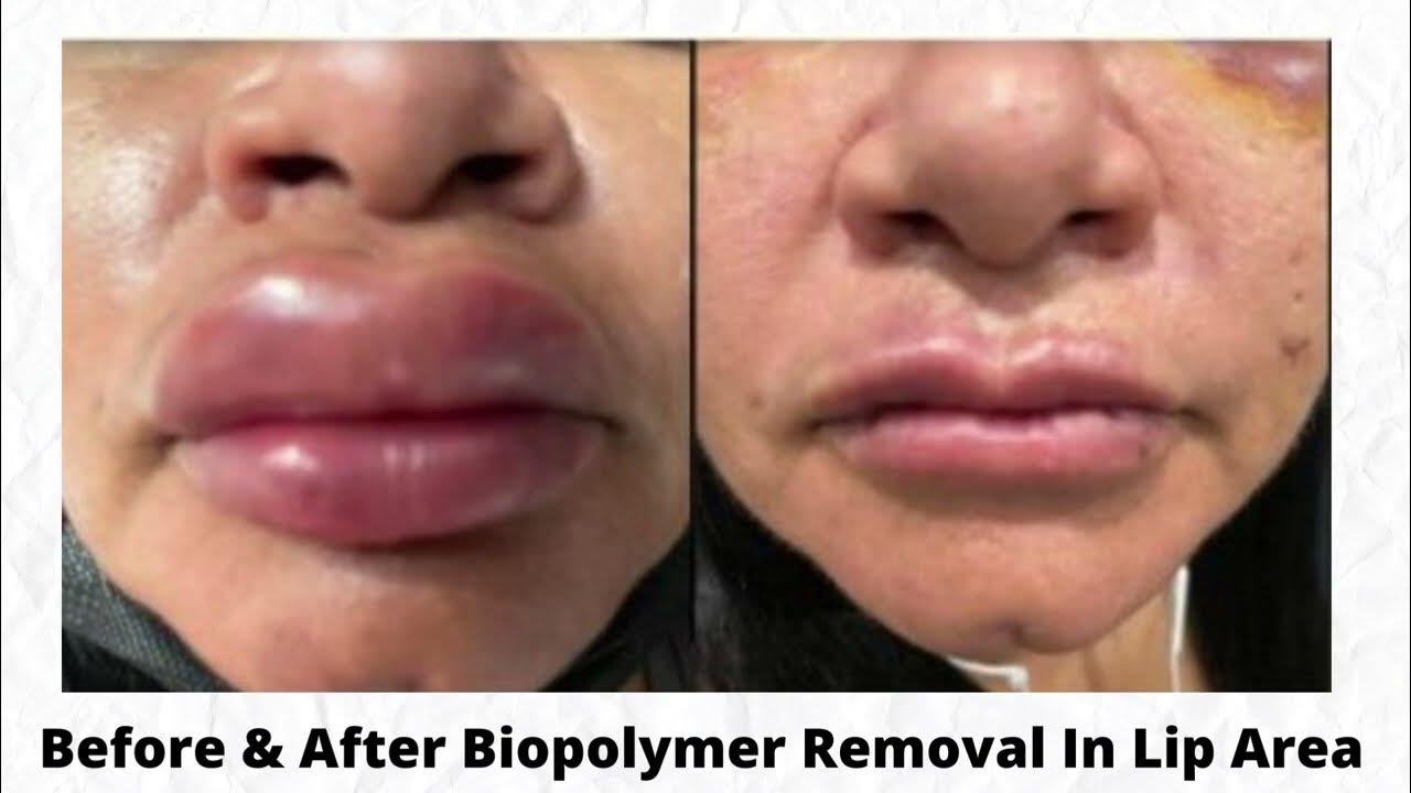 Biopolymer Injections in Lip Area HD Esthetique Miami, FL YouTube