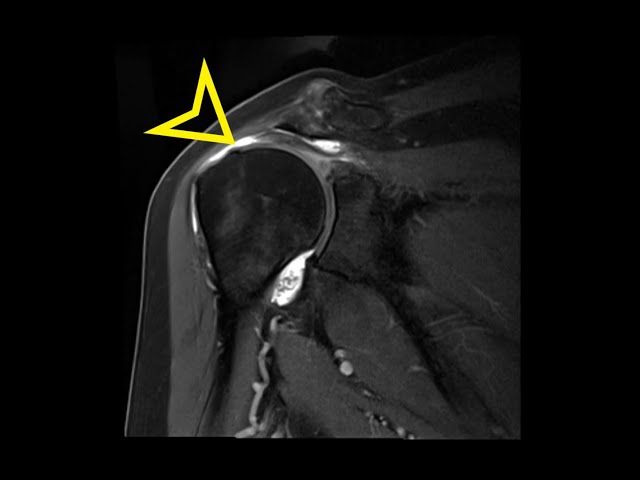 supraspinatus tear mri