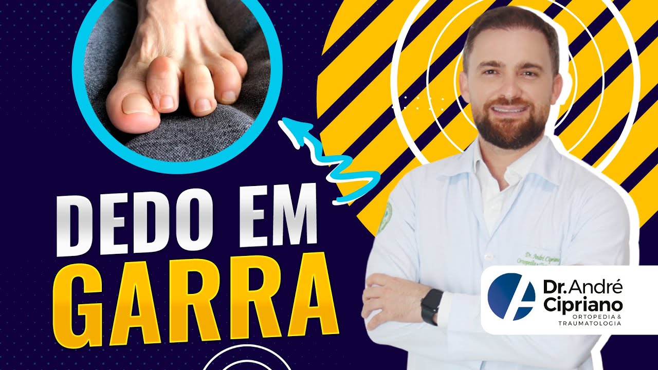 Dedo em garra - deformidade nos dedos do pé