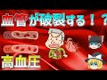 【ゆっくり解説】血管が破裂する病気！？本当は怖い高血圧