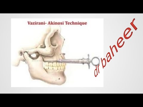 Akinosi technique ( closed mouth injection) - YouTube