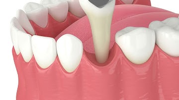 Tooth Extraction (3D Animation)
