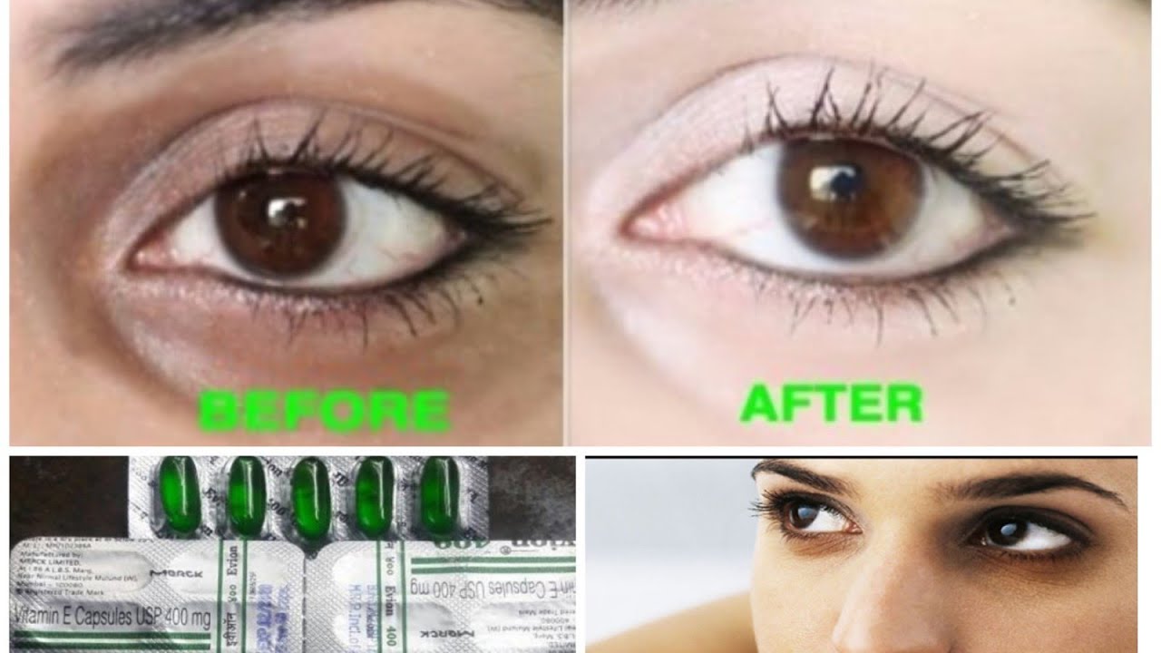 vitamin e for removing tagit on eyelid vitamin e for removing tagit on eyelid