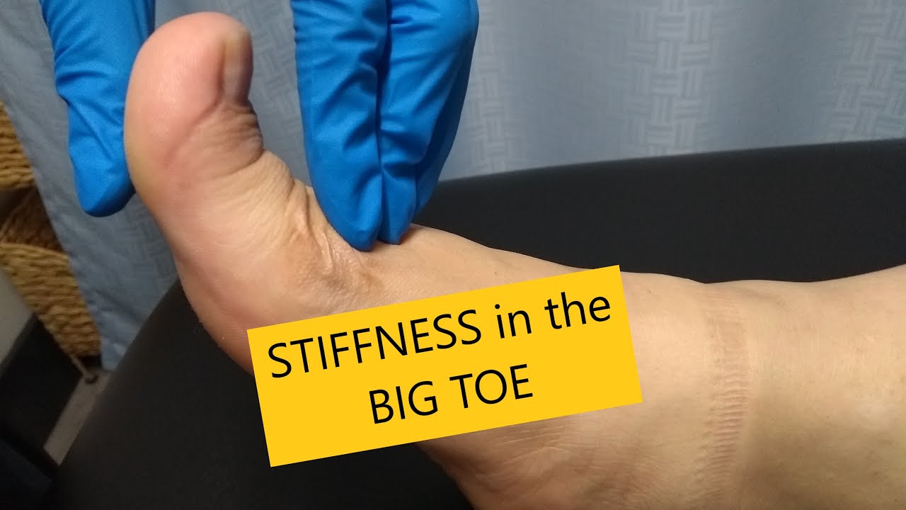 The Importance Of Great Toe Extension Hallux Rigidis Stiff Big Toe the-importance-of-great-toe-extension-hallux-rigidis-stiff-big-toe