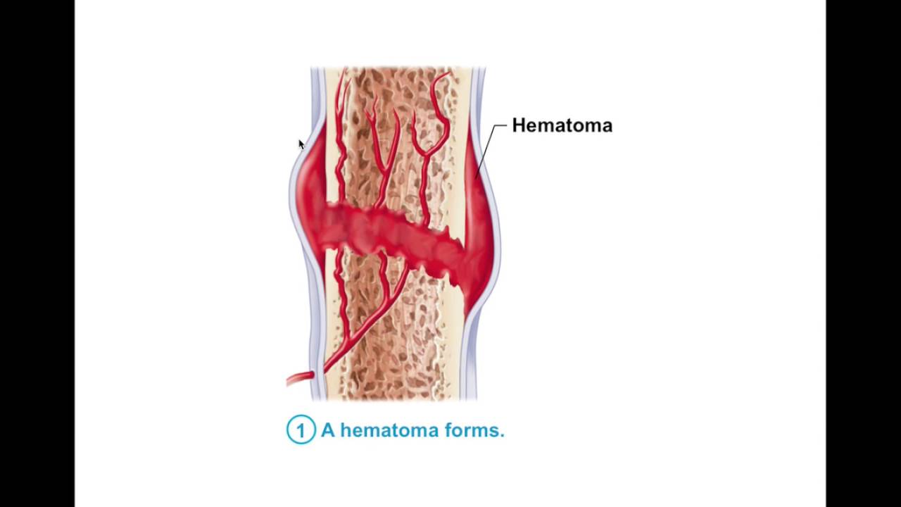 Chapter 6.7 Bone Repair BIO201