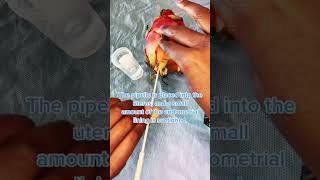 What is an Endometrial Biopsy?