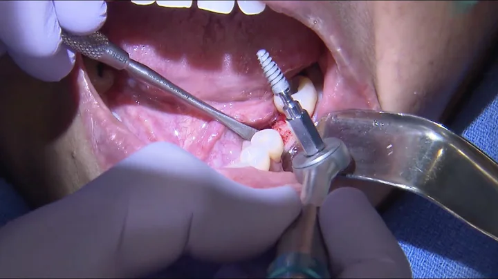 Case of the Week: The Fundamentals of Placing Implants