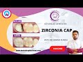 Must watch before going for crown (cap) over your tooth l what is zirconia crown (metal free cap)