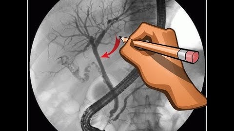 ERCP -   x ray Interpretation