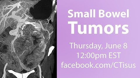 Facebook Live: Small Bowel Tumors