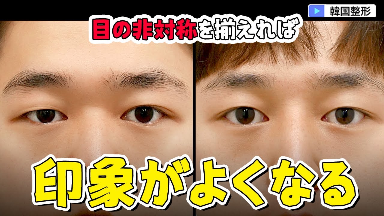#目の左右差 #非対称目 #整形ビフォーアフター