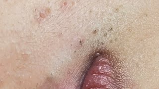 Lip acne 