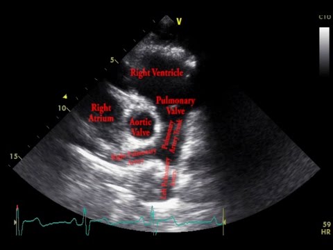 Echocardiogram Parasternal Short Axis View Pulmonary Arteries - Loop