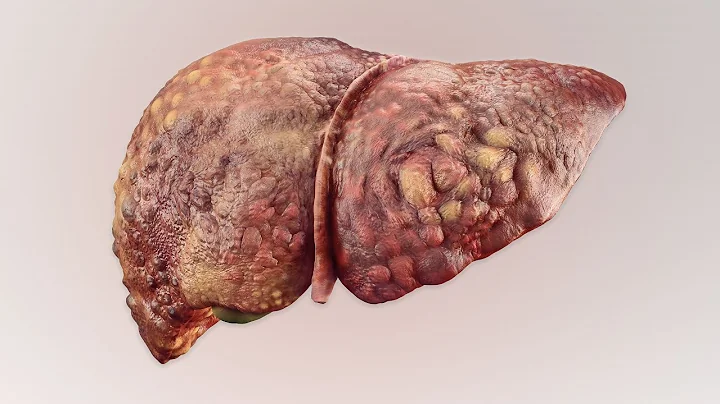 A Man Drank 3 Liters Rum Everyday Since Age 13. This is What Happened To His Liver. - DayDayNews